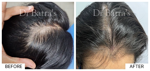 Hair Falling Treatment